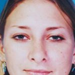 Rhinoplasty Before & After Patient #4796