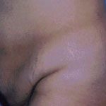 Tummy Tuck Before & After Patient #4862