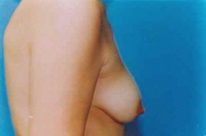 Breast Lift Before & After Patient #5021