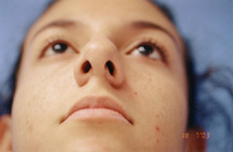 Rhinoplasty Before & After Patient #4803