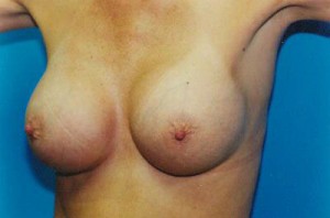 Breast Augmentation Before & After Patient #4934