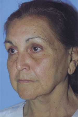 Facelift / Blepharoplasty Before & After Patient #4768
