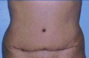 Tummy Tuck Before & After Patient #4874