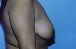 Breast Lift Before & After Patient #5035