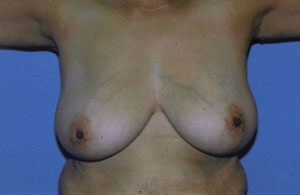 Breast Lift Before & After Patient #5047