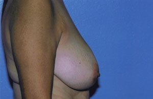 Breast Lift Before & After Patient #5047