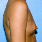 Breast Augmentation Before & After Patient #4969