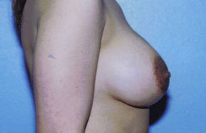 Breast Augmentation Before & After Patient #5000